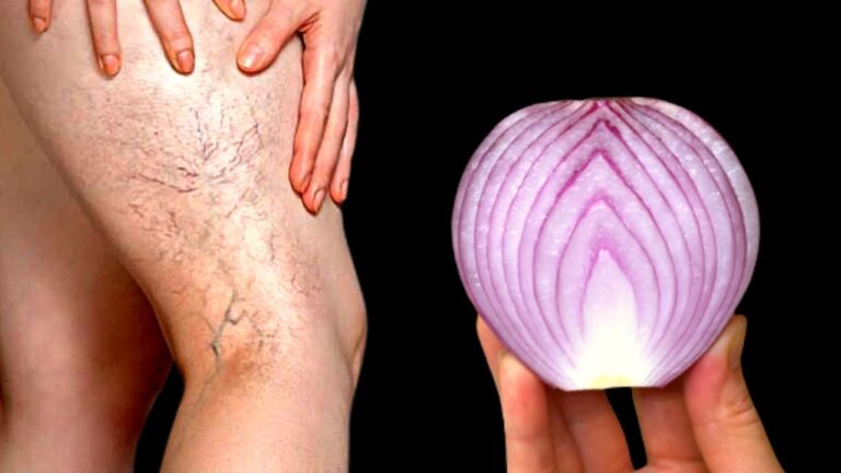 10 astuces pour dire adieu aux varices et retrouver des jambes légères !