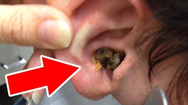 Éliminez le cerumen en excès en seulement 10 minutes avec ce truc simple !