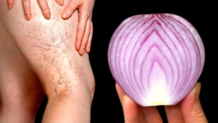 Éliminez 5 astuces naturelles contre les varices et la douleur !