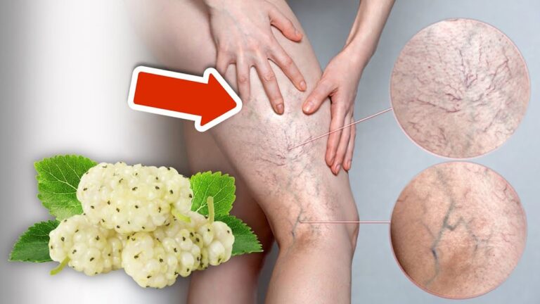 Éliminez 5 astuces pour dire adieu aux varices définitivement !