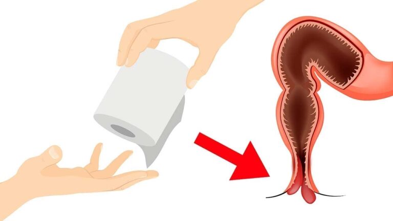 5 astuces naturelles pour éliminer définitivement les hémorroïdes !