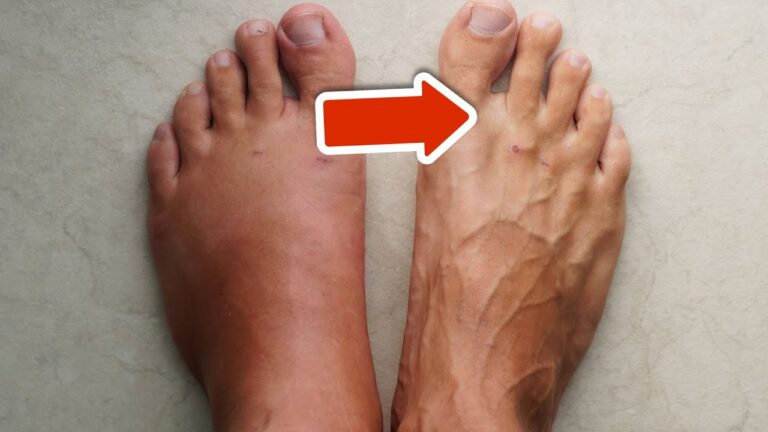 Découvrez 5 vitamines pour réduire efficacement les gonflements aux jambes et pieds !