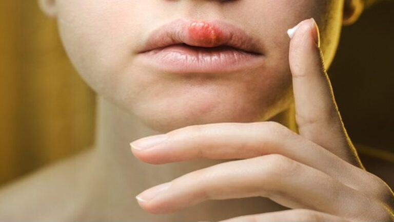 7 remèdes naturels pour traiter l&rsquo;herpès labial aussi vite que les médicaments